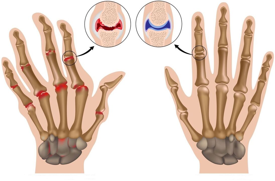 Hondrolife restore joint