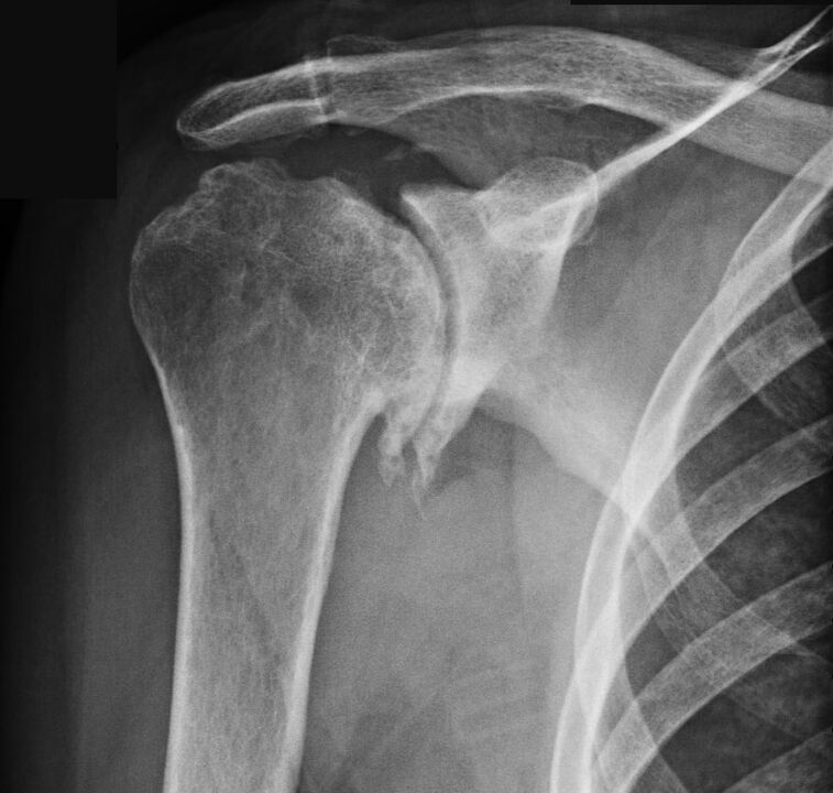 X-ray showing the shoulder joint