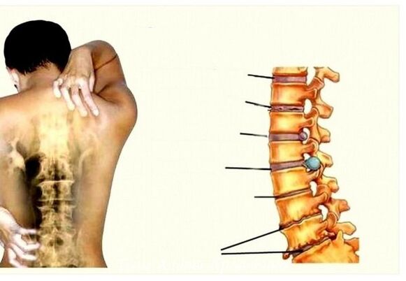 Stages of cervical osteochondrosis