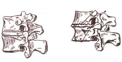The development stage of cervical osteochondrosis