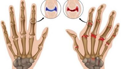 The main differences between arthritis and arthritis