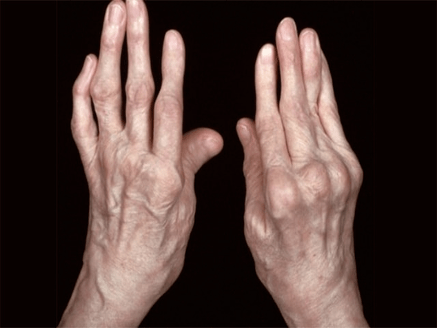 Arthritis is the cause of joint pain in the fingers