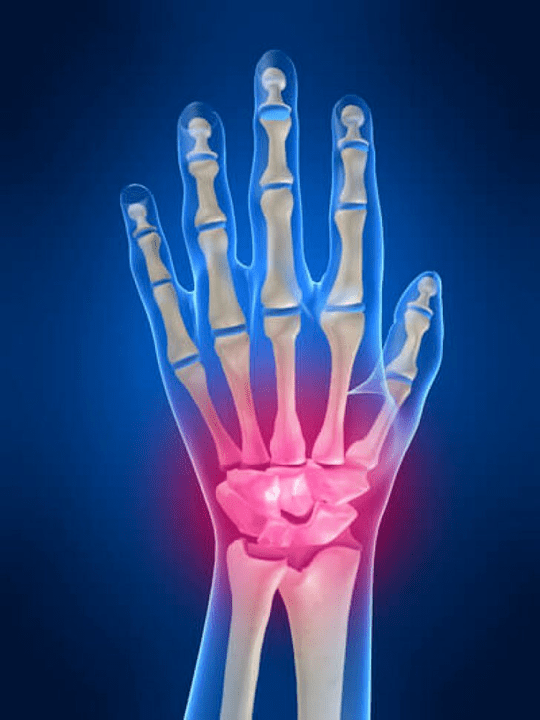 Arthritis