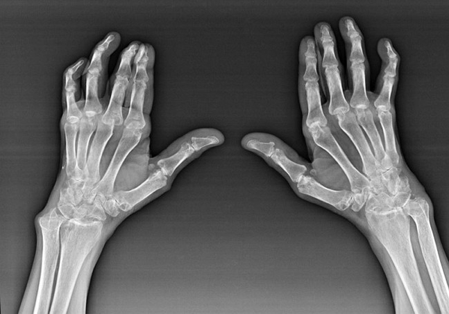Diagnosis of finger joints