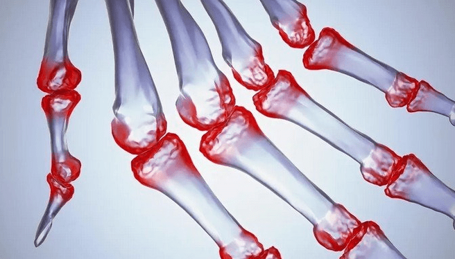 Finger joint pain