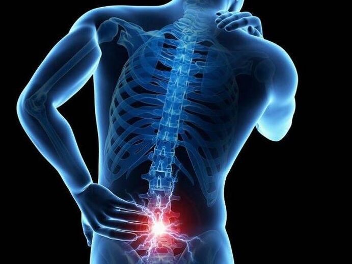 In radiculitis, compression of the nerve root can cause severe pain in the lower back