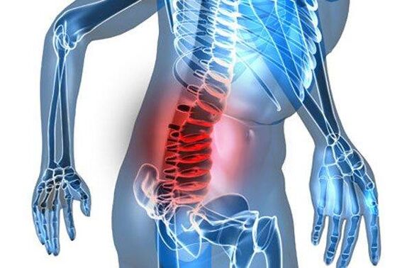 Lumbar osteochondrosis stage 4 spinal deformity