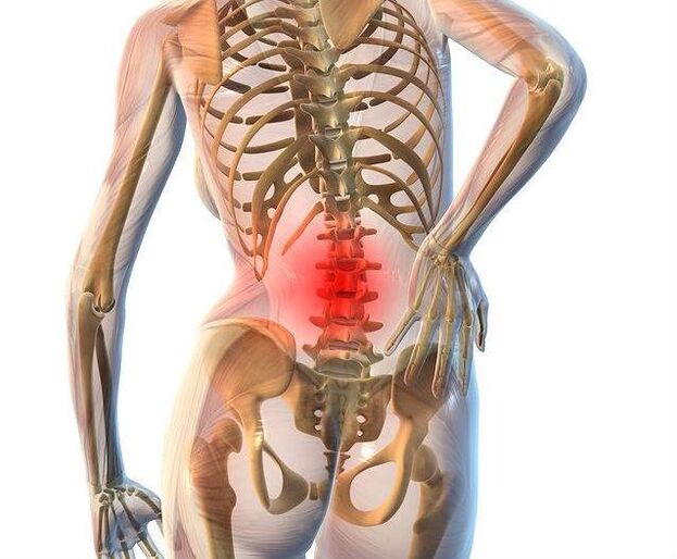 Lumbar osteochondrosis