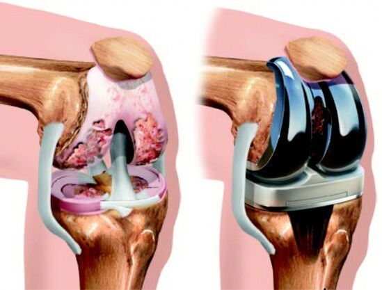 Endoprosthetic replacement is a surgical treatment that replaces the affected joint with a prosthesis.