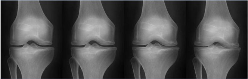 Arthropathy staging according to Kellgren-Lawrence classification