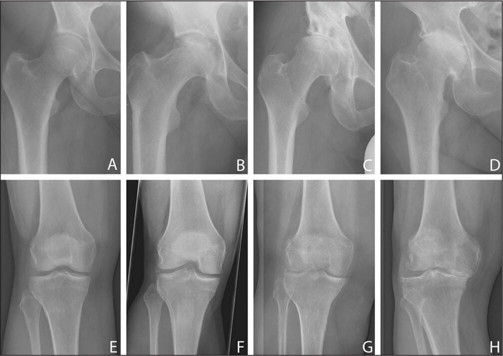 Stages of development of arthrosis on X-ray