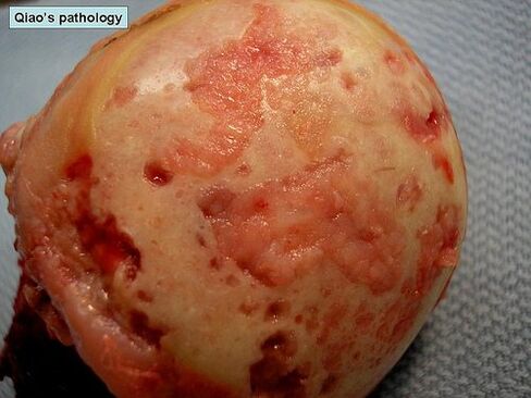 cartilage surfaces affected by arthrosis