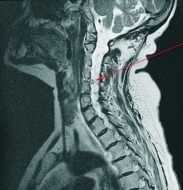 Cervical intervertebral hernia on MRI