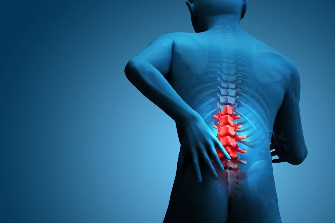 Pain caused by lumbar osteochondrosis